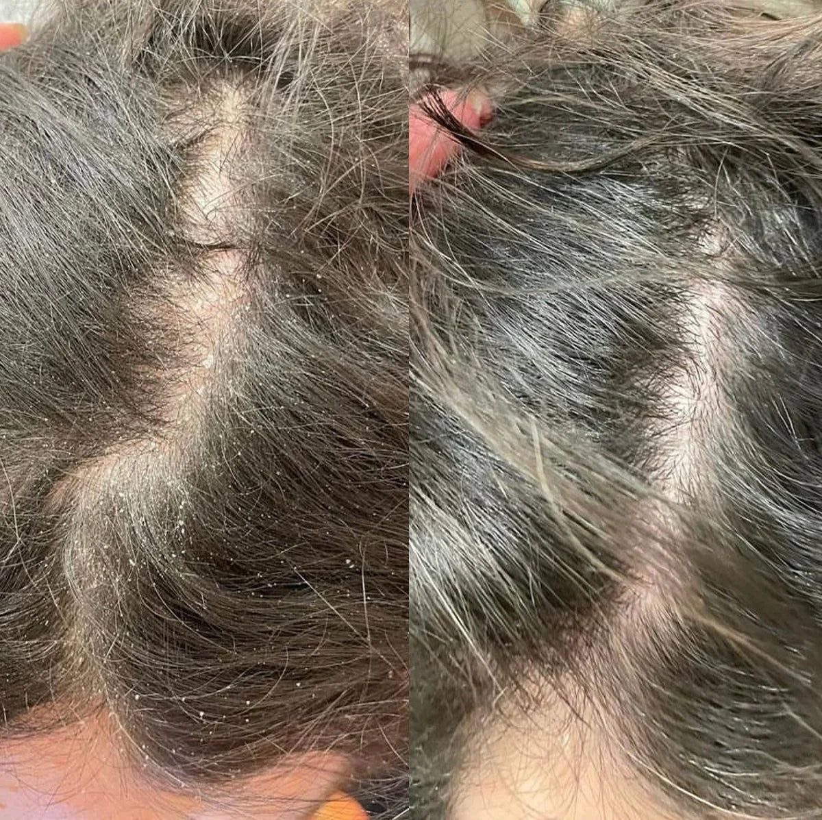 Gotero Anti-Caspa Herbal Hair Tonic